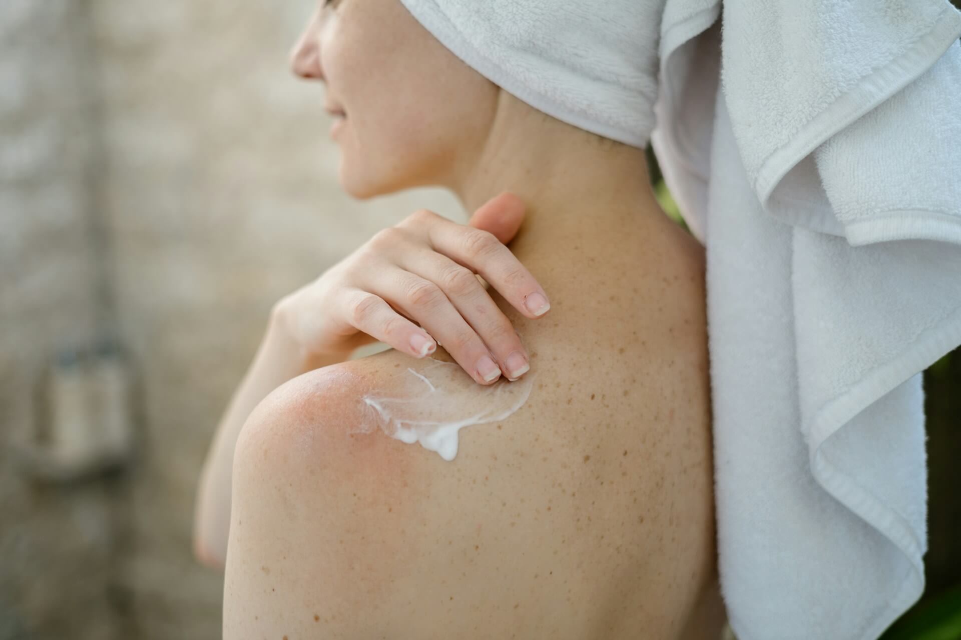 Understanding and Managing Scalp Psoriasis: A Comprehensive Guide